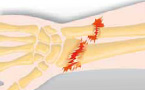 Vai all'articolo: Lesioni sportive: Fratture ossee