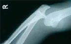 À l'article: Blessures sportives: Luxation