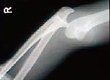 Blessures sportives: Luxation Blessures sportives: Luxation